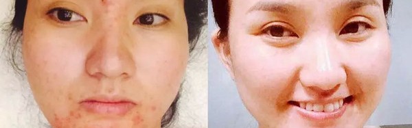 专注祛痘12年，花钱都买不到的经验，不看活该你长痘！