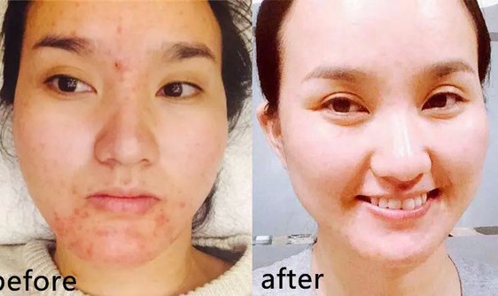 专注祛痘12年，花钱都买不到的经验，不看活该你长痘！