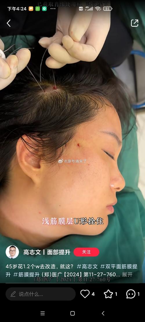 热5约不上,线雕又怕疼,这些新的医美技术你赶紧来围观!