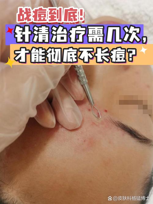 那些从不长痘的人，到底做了啥？